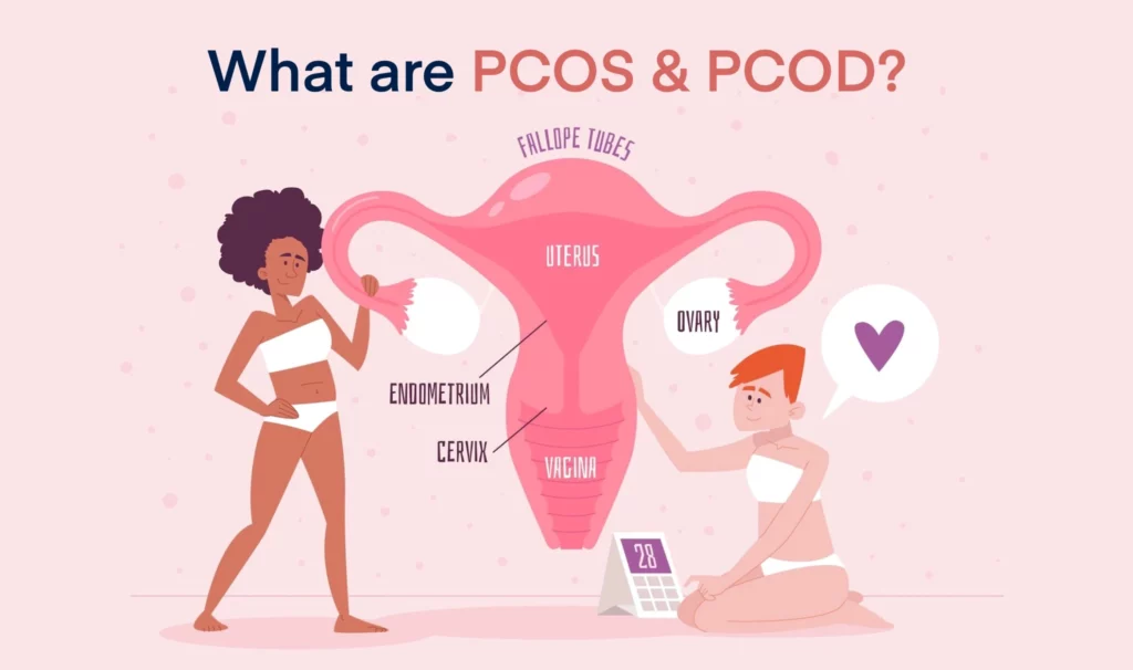 PCOD vs PCOS